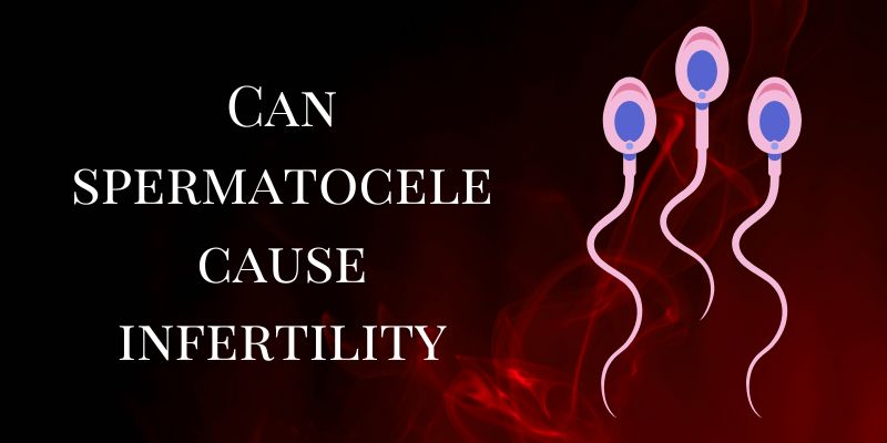 Can Spermatocele Cause Infertility - Liv Muztang