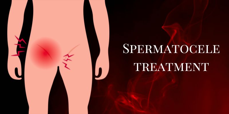 Spermatocele Treatment - Liv Muztang