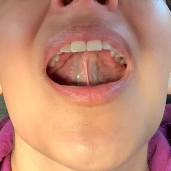 Image of a girl showing Right Tongue Placement, highlighting the correct position of the tongue for optimal oral health and facial structure enhancement.