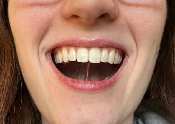 Image of a girl demonstrating correct mewing technique, showcasing the optimal tongue posture against the roof of the mouth for facial structure improvement.
