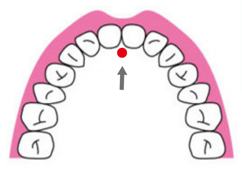 口蓋に赤い点が表示され、口腔の健康や言語療法の演習で集中的に注意を払う特定の領域が強調表示されている画像。