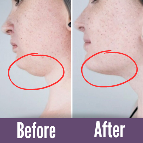 Comparative image showing 'Before and After' results of a double chin, demonstrating the effectiveness of targeted exercises or treatments