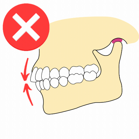 「歯の接触習慣」を描いた画像。歯を接触させる一般的な習慣と、それが歯と顔の健康に及ぼす潜在的な影響を示しています。