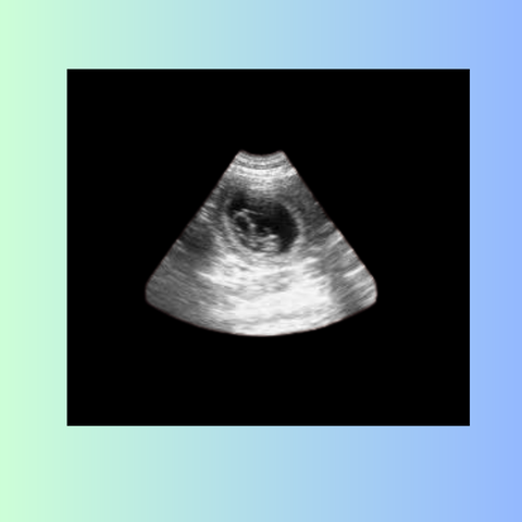 7 Weeks Pregnant Ultrasound Picture