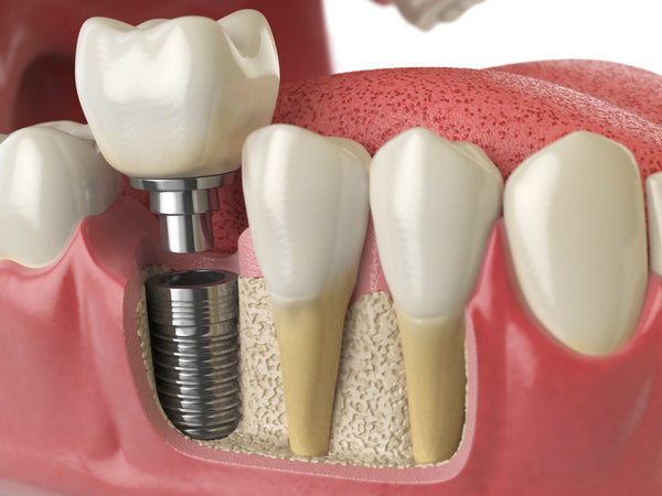 dental-implants-supplies-quality-of-life-healthy-teeth-implant-dentistry-oral-hygiene