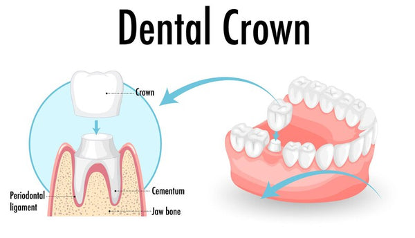 temporary-crown