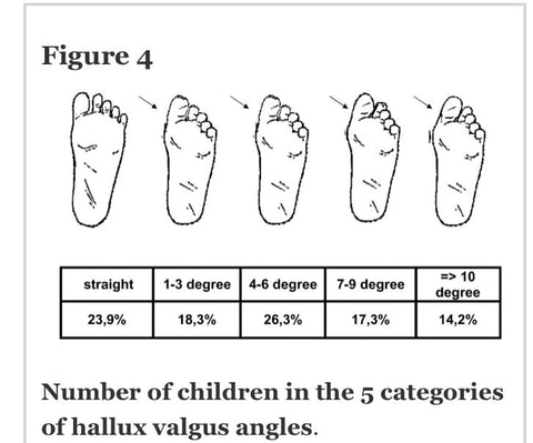 Only 24 % of preschool children had a straight great toe position