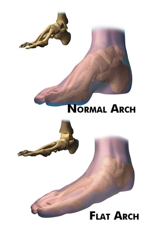 Correctly developed foot arch versus a flatfoot