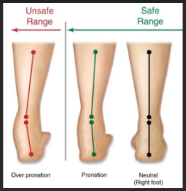 Overpronation can be avoided by wearing shoes with arch support