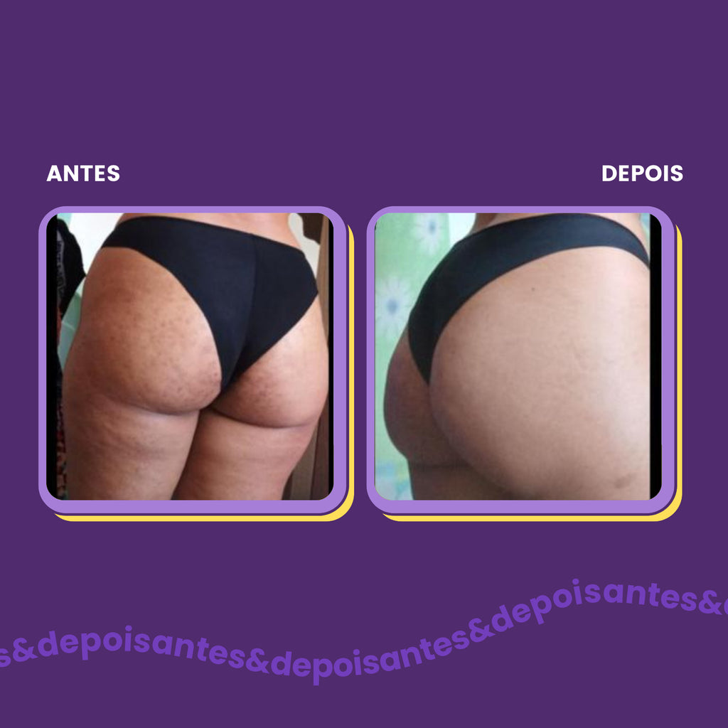 antes e depois foliculite