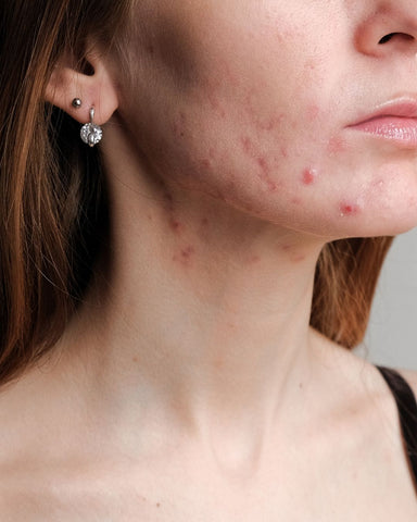 girl with acne on her chin