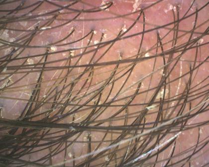 scalp with dandruff