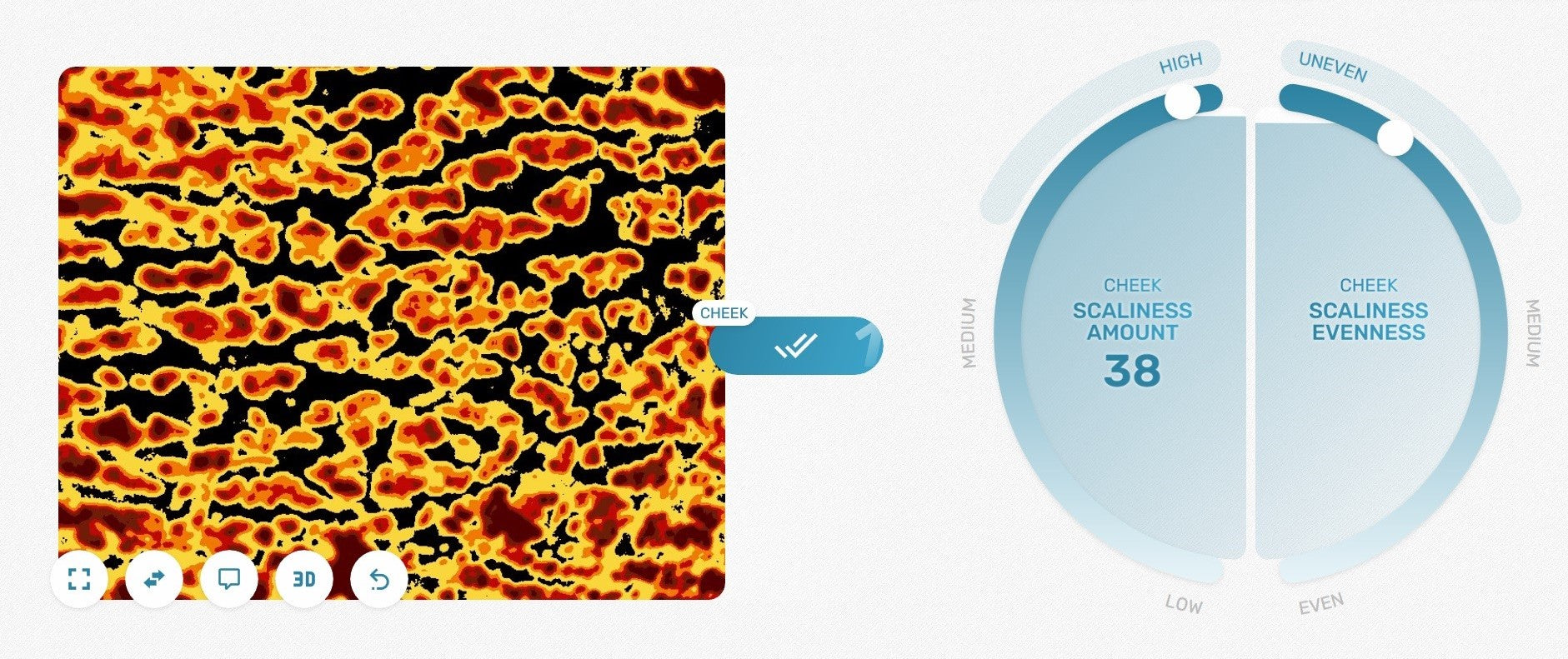 Skin scaliness evaluated by Corneofix®