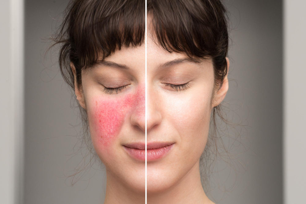 Rosacea before and after