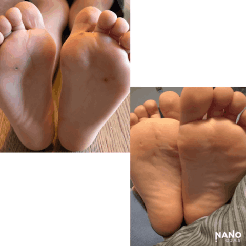 foot wart remedy before and after