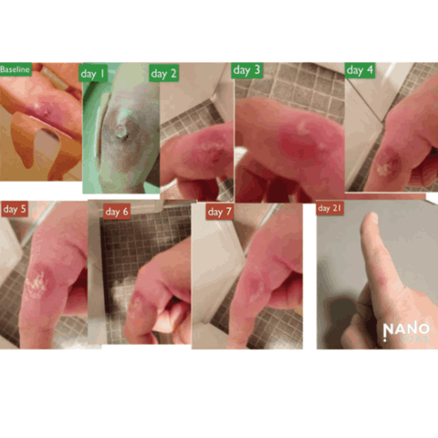 before and after metadichol for skin condition