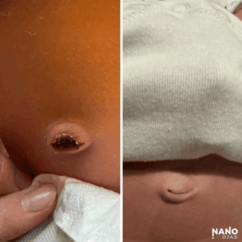 before and after homeopathic umbilical cord remedy