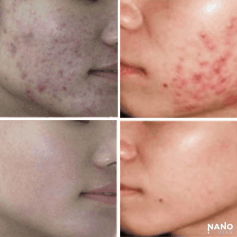 acne homeopathic remedy before and after