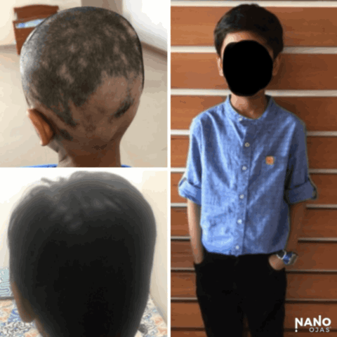 before and after homeopathic hair regrowth
