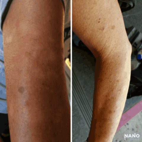 before and after metadichol for skin