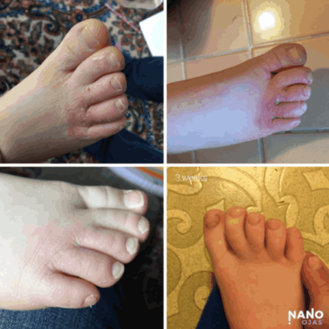 foot skin remedy before and after
