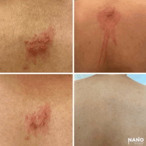 natural rash remedy before and after