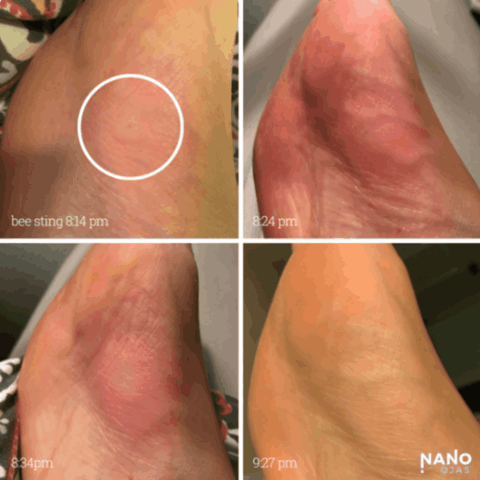 natural bee sting relief before and after