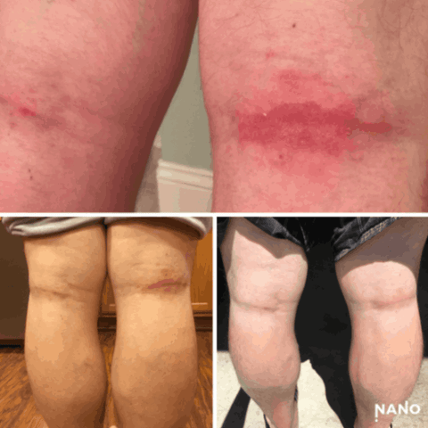 vefore and after nanotechnology for knee skin