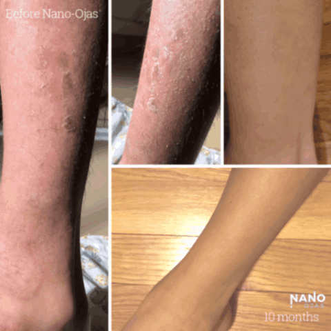 before and after dry skin nanotechnology