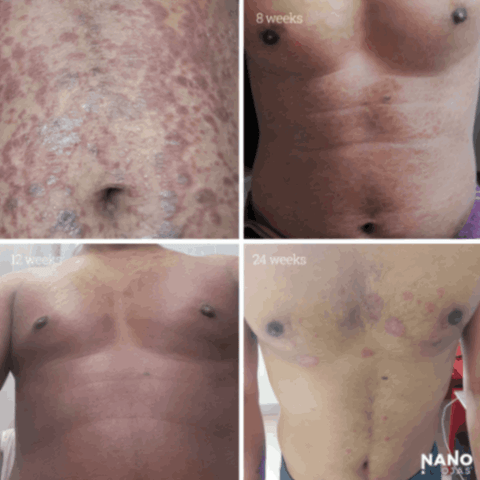 before and after metadichol for skin condition