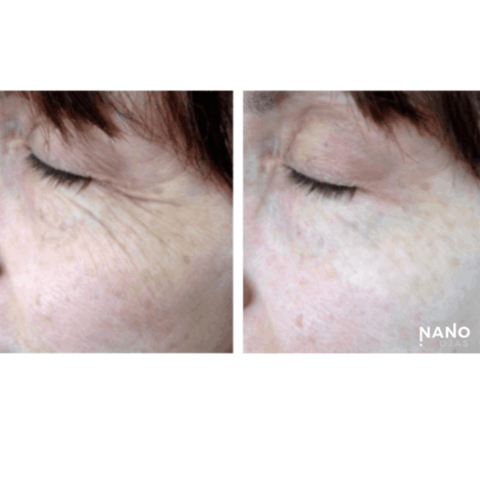 face wrinkle homeopathic remedy before and after