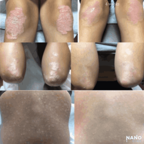 before and after skin healing with nanotechnology