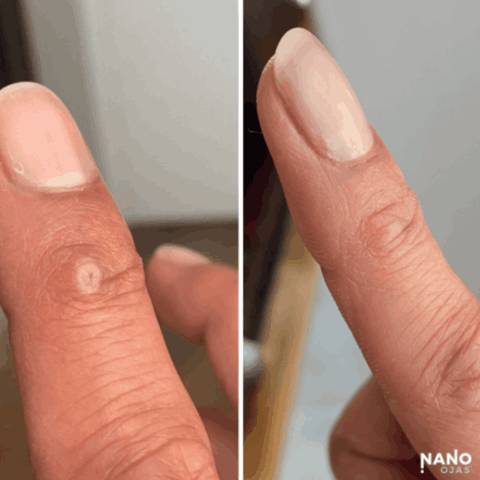 finger wart homeopathic remedy before and after