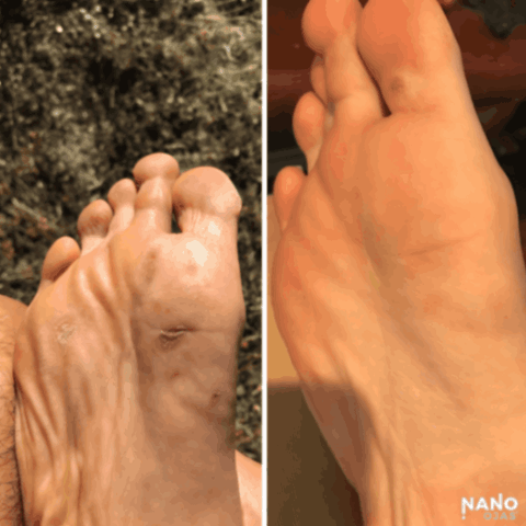 foot wound natural remedy before and after
