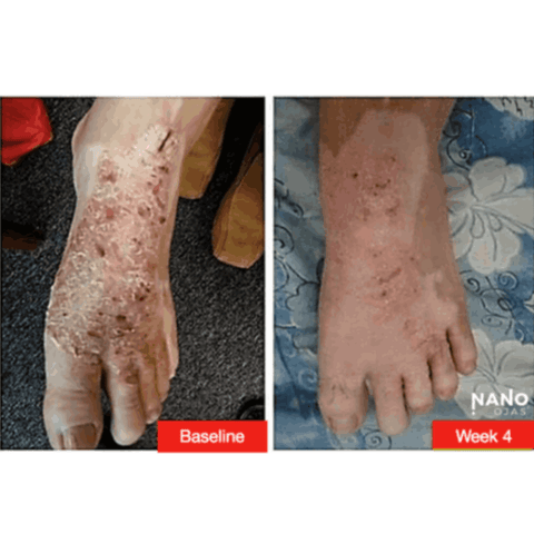 dry foot skin remedy before and after