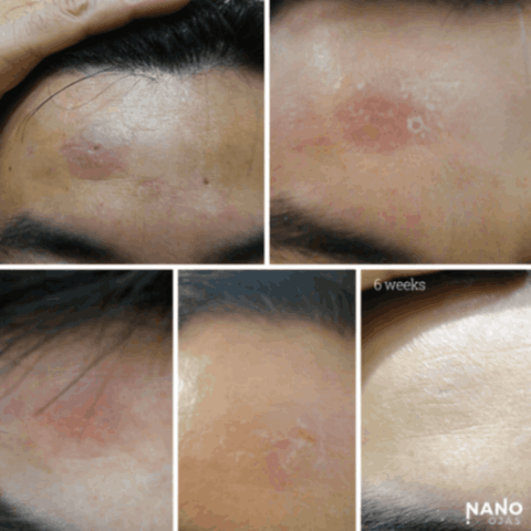 before and after metadichol for blemish