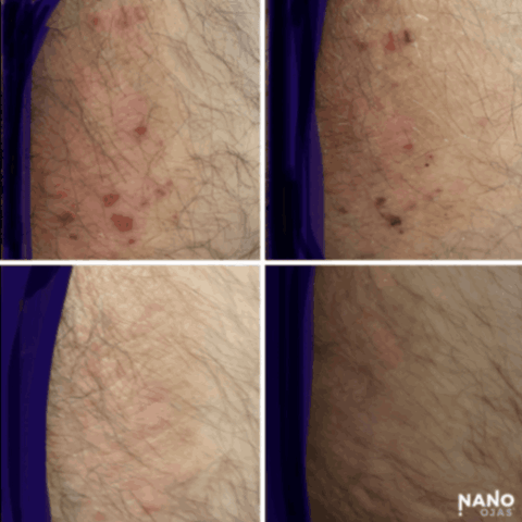 scab before and after nanotechnology