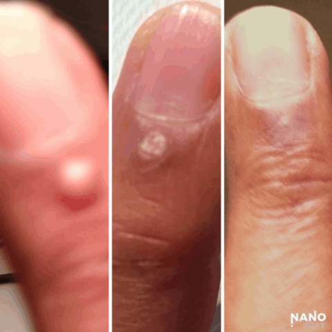 natural wart relief before and after