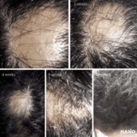 hair growth homeopathic before and after