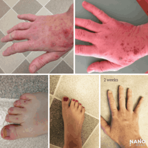 before and after hand skin nanotechnology