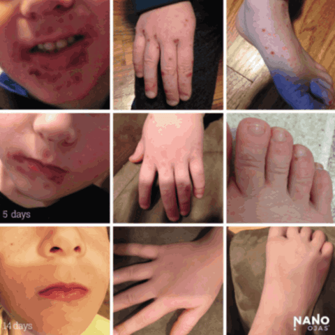 before and after homeopathic remedy for child skin