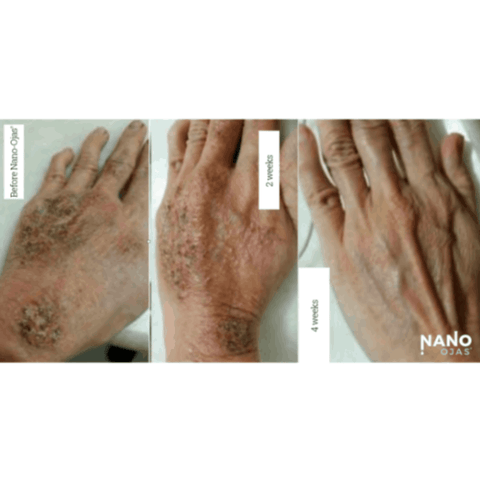 before and after nanotechnology skin healing