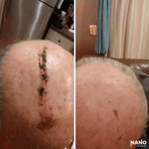 before and after metadichol for head injury