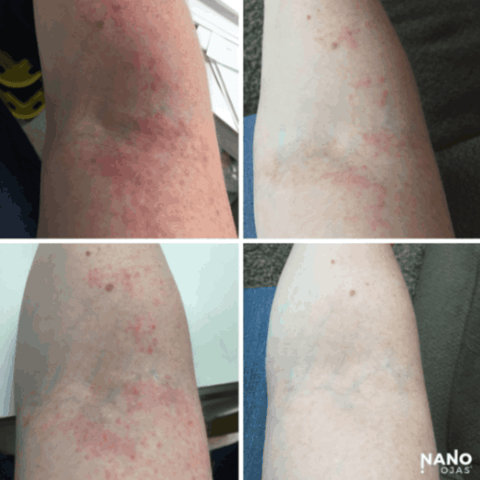 before and after nano ojas for skin