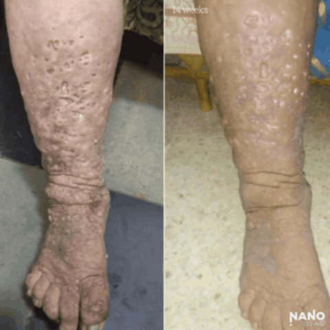 skin pock mark homeopathic remedy before and after