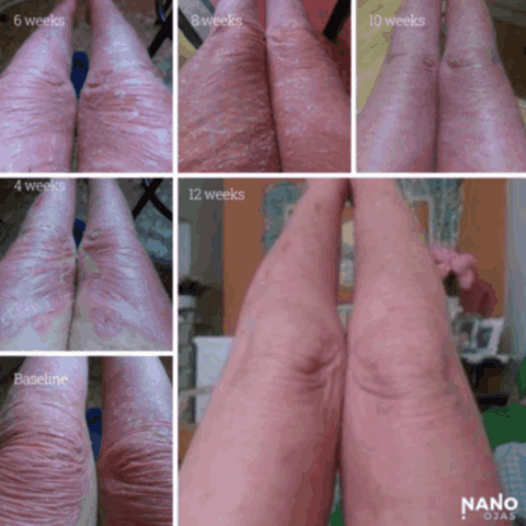 before and after skin nanotechnology