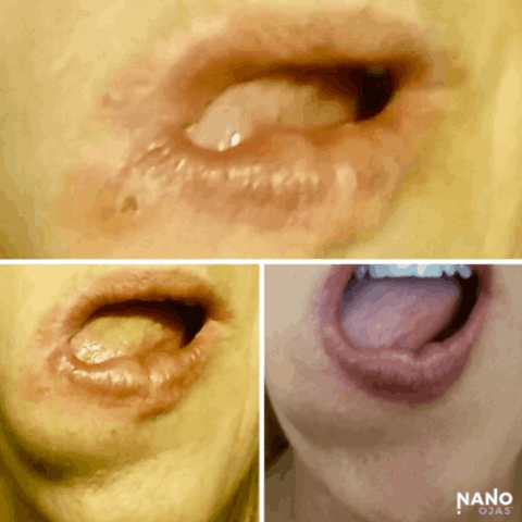 before and after metadichol for mouth sores