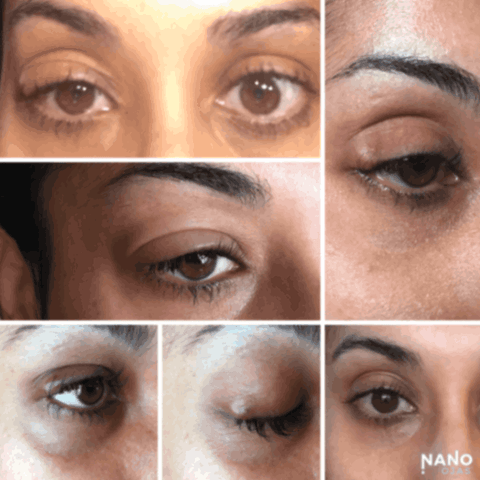 before and after eye irritation homeopathic remedy