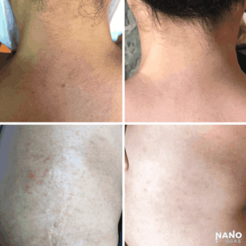 before and after skin irritation nanotechnology