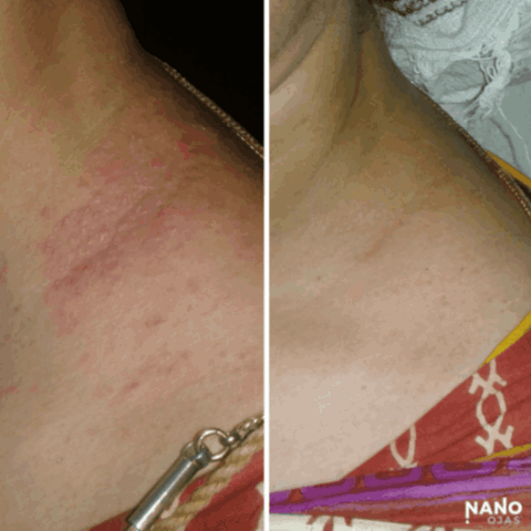 before and after rash relief nanotechnology